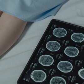 ADHD in Adults: Often Missed but Treatable